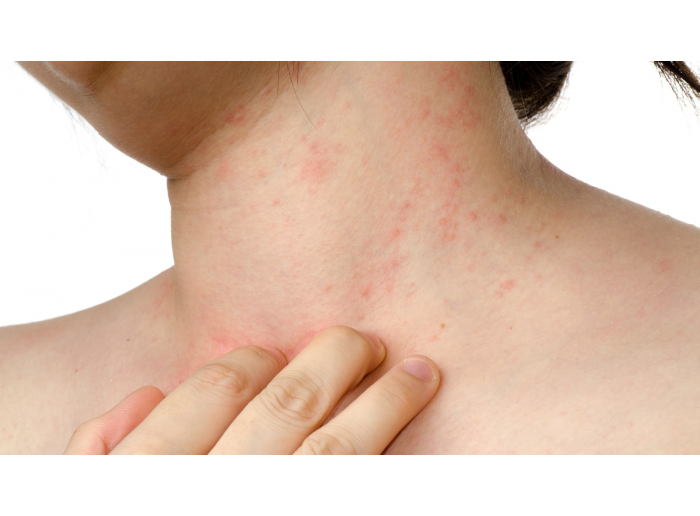 PSORIASIS: ¿QUÉ ES?, TIPOS, CAUSAS Y POSIBLES CURAS